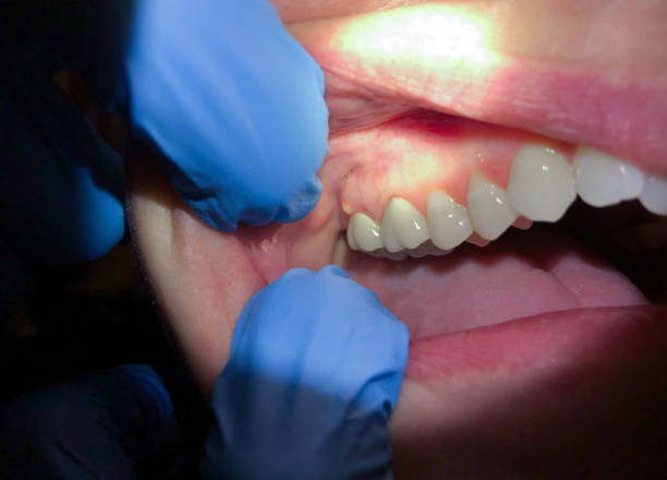 Best Emergency Dentist for Lost Fillings or Crowns in Webb City, MO